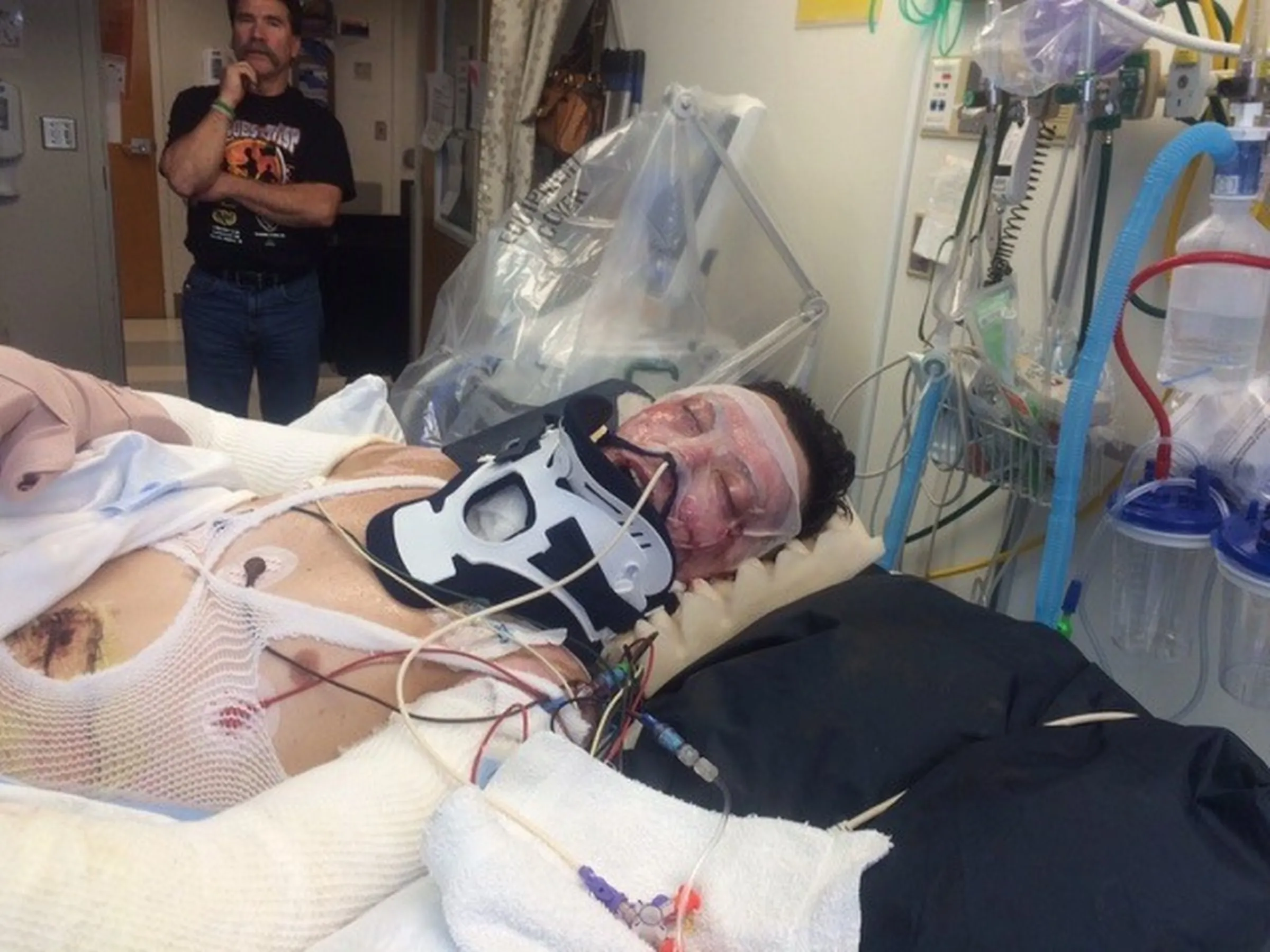 Firefighter Daniel Lyon lies in a hospital bed after 65% of his body was burned in a fire in Washington state, in this undated.