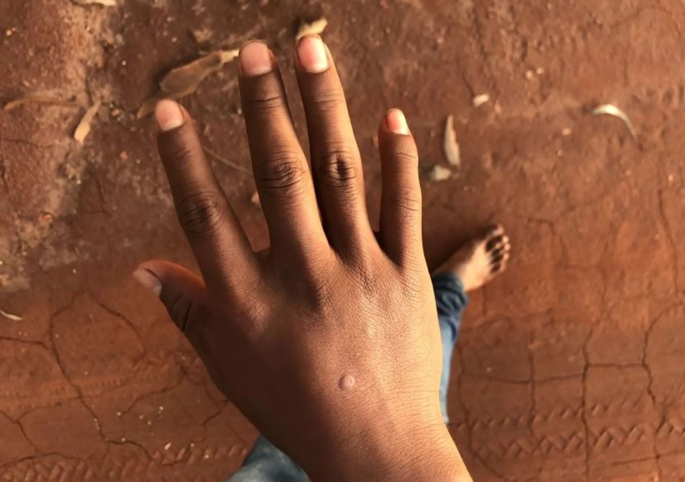 16 year old Guarani-Kaiowá boy shows his right hand, shot through during a Military Police raid in the 24th of June, at the Guapoy occupation, by the Amambai Indigenous Reserve, Amambai, Brazil, September, 17, 2022. Thomson Reuters Foundation/André Cabette Fábio