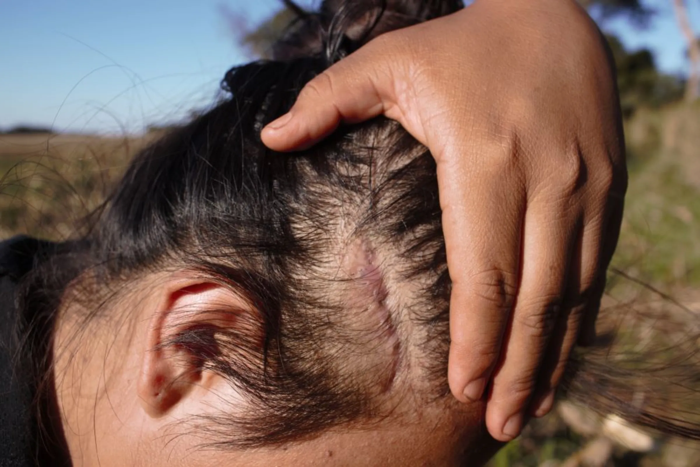 22 year old student shows a graze bullet scar gained during a 24th of June Military Police raid, by a corn field at the Guapoy occupation, near the Amambai Indigenous Reserve, in Amambai, Brazil, September, 17, 2022. Thomson Reuters Foundation/André Cabette Fábio