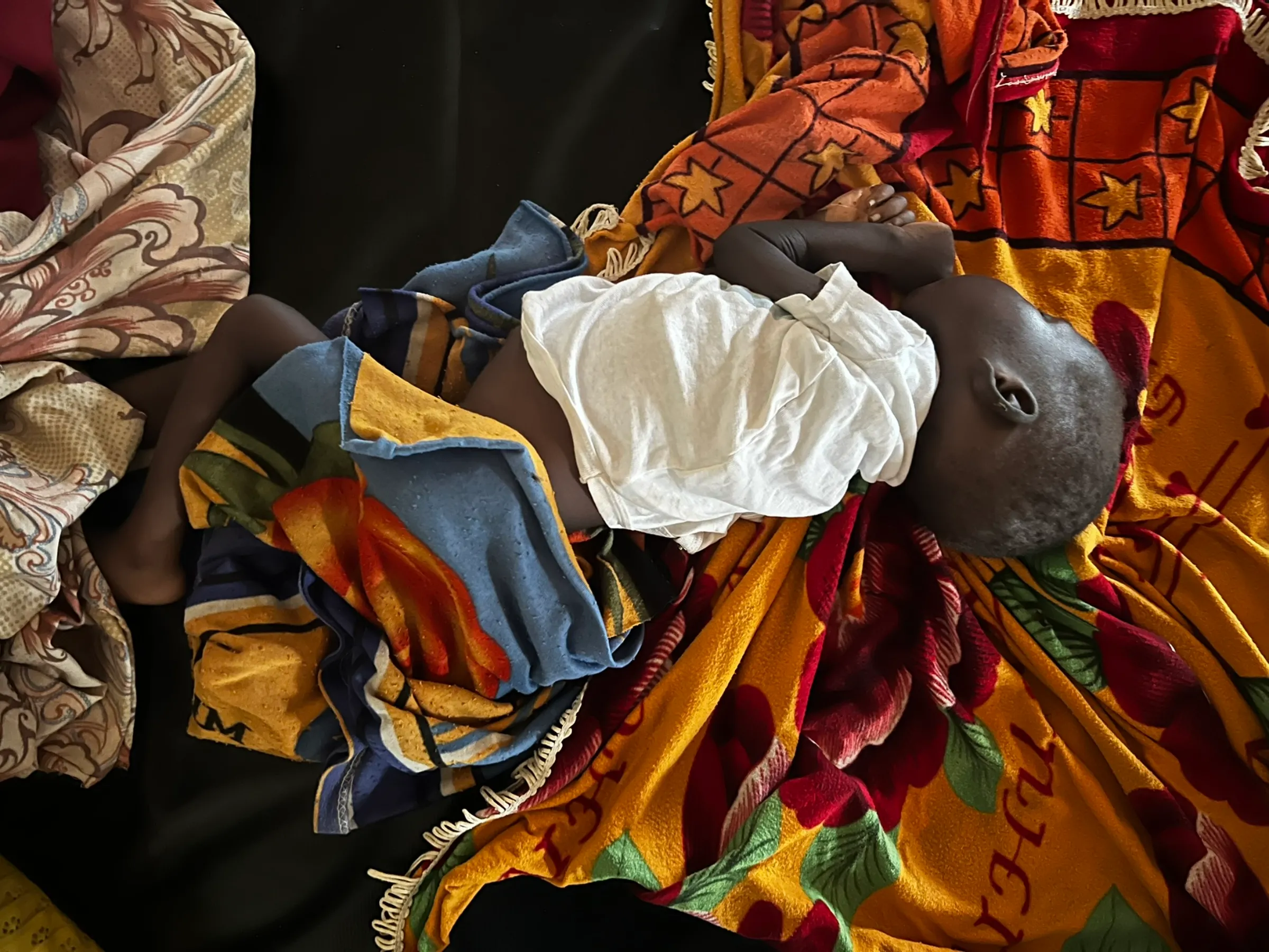 A malnourished child from Sudan gets treatment at Bunj Hospital in Maban county, South Sudan on July 31, 2024. Sudan's war has led to severe food shortages and famine in some parts of the country, more than 700,000 children are at risk of severe acute malnutrition. Thomson Reuters Foundation/Nita Bhalla