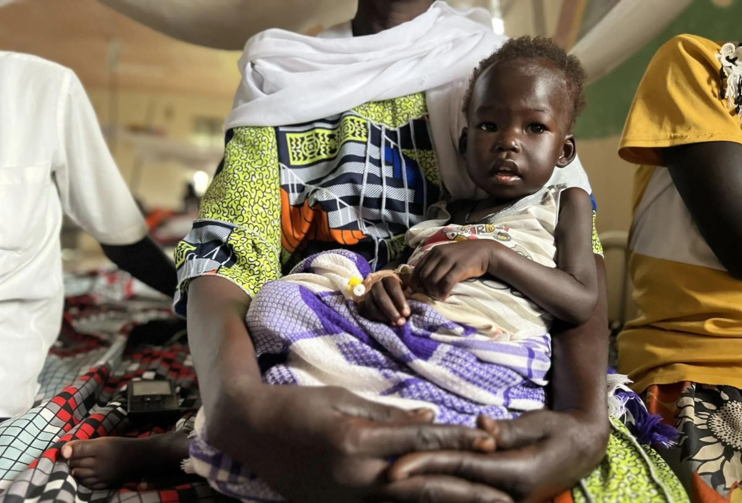 A malnourished child from Sudan gets treatment at Bunj Hospital in Maban county, South Sudan on July 31, 2024. Sudan's war has led to severe food shortages and famine in some parts of the country, more than 700,000 children are at risk of severe acute malnutrition. Thomson Reuters Foundation/Nita Bhalla