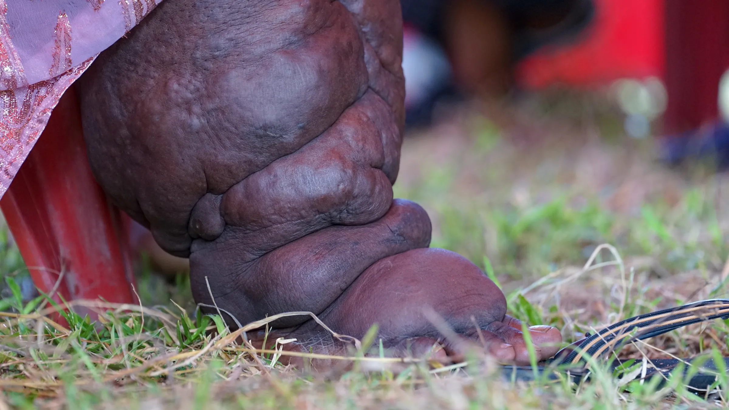 A woman shows her leg swollen by elephantiasis, which is caused by a parasitic worm and spread by mosquitos, in Kwale, southern Kenya, East Africa. END Fund/Handout via Thomson Reuters Foundation